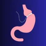 L’ anneau virtuel gastrique en hypnose